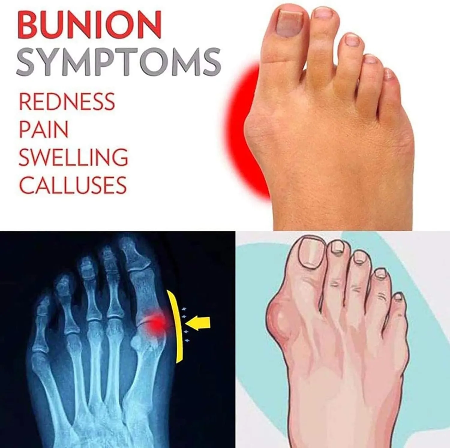 Women's Big Toe Bone Correction Sandals, Summer Bow-knot Flat with Arch Support Non-slip Wear-resistant Beach Travel Slippers, for Women Hallux Valgus Bunion